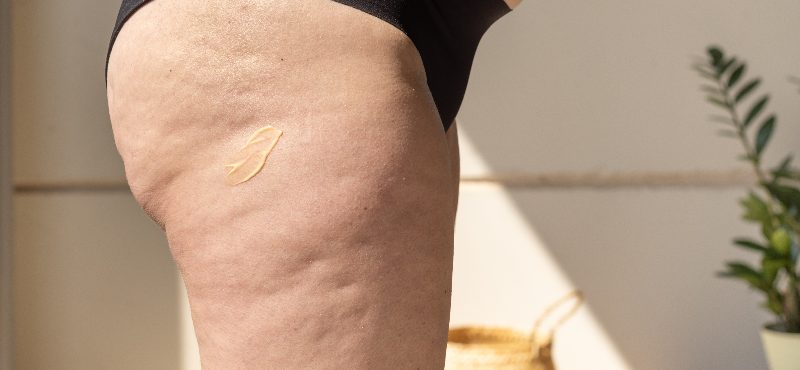 Cellulite